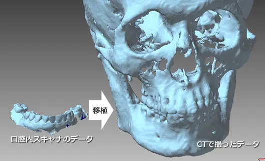 POLYGONALmeisterで口腔内スキャナのデータをCTスキャンデータに統合した3Dモデル表示