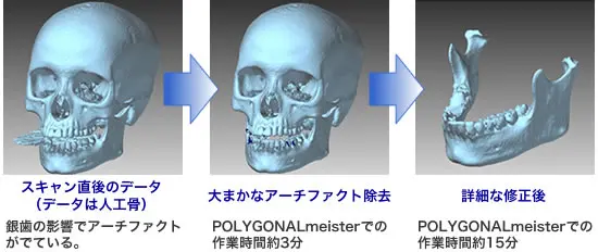 POLYGONALmeisterで人工頭蓋骨データのアーチファクト除去と修正を行う過程