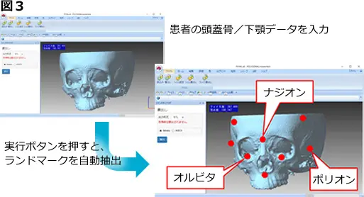 患者頭蓋骨3Dデータを読み込み、ナジオン・オルビタ・ポリオンなど頭部ランドマークを自動抽出するソフト画面の比較イメージ